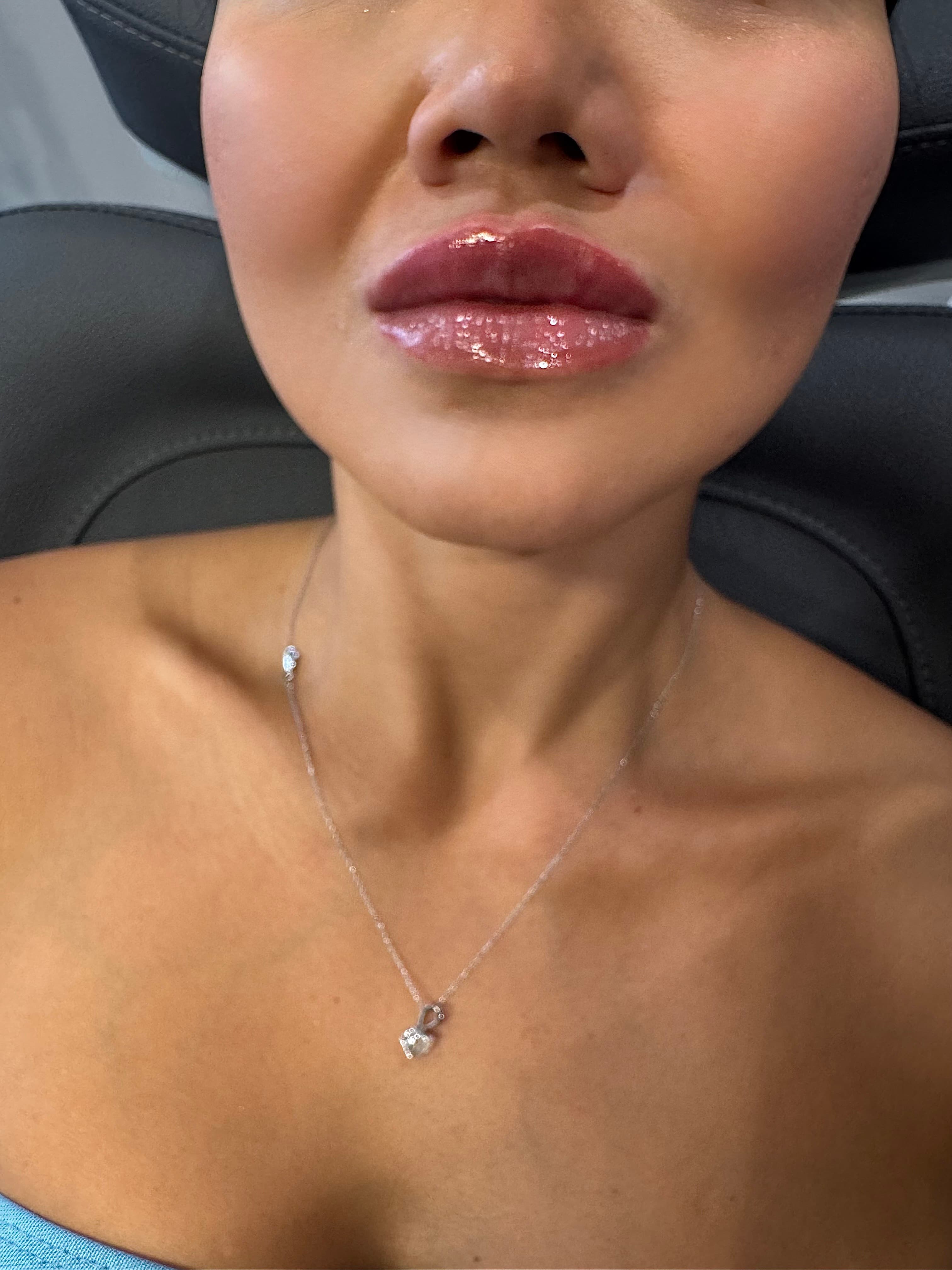 Lip filler results showing enhanced volume and definition