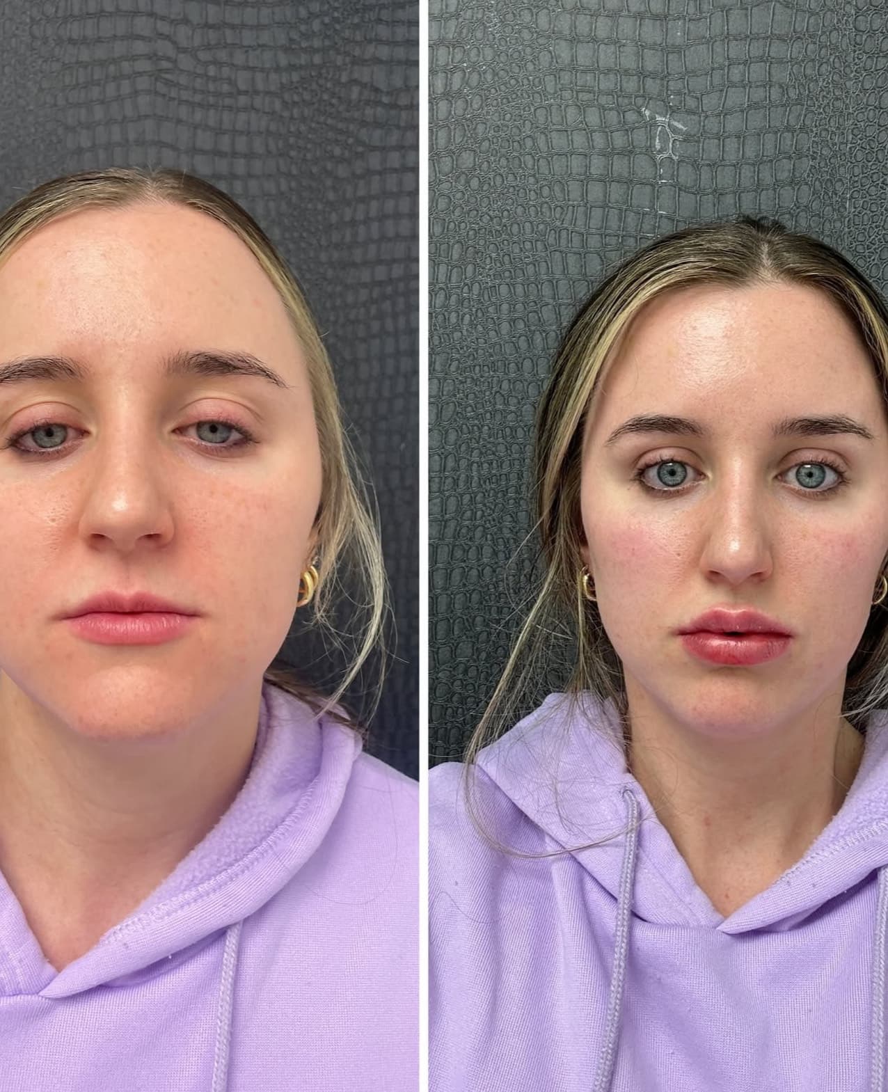 Before and after facial contouring results